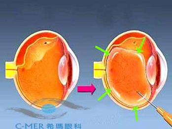 希瑪林順潮眼科中心_視網膜脫落_充氣性視網膜固定術