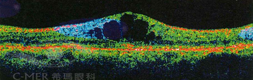 希瑪林順潮眼科中心_視網膜脫落_糖尿病視網膜病變