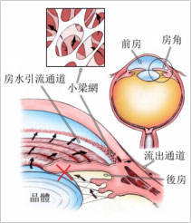 希瑪林順潮眼科中心_青光眼_白內障所致青光眼