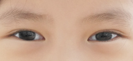 希瑪林順潮眼科中心_兒童斜弱視_斜視正常眼位